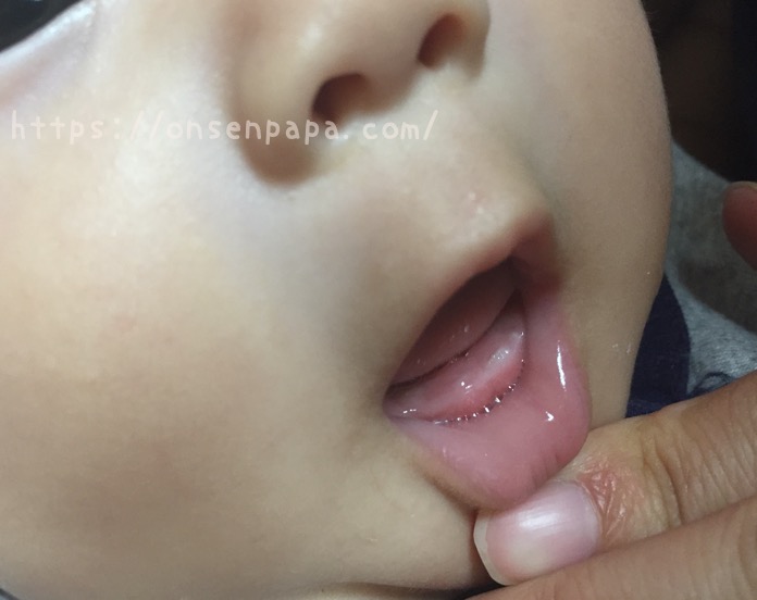 赤ちゃん　ビスコ　いつから 赤ちゃん　乳歯