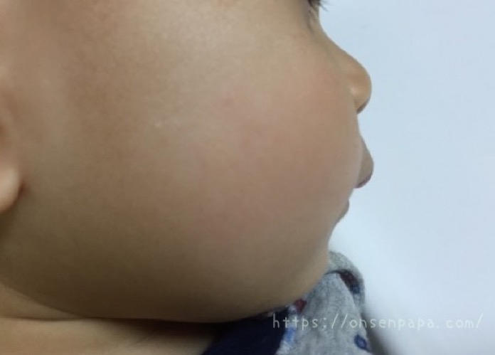 赤ちゃんの頬の肌荒れは指しゃぶりが原因 対策をご紹介します