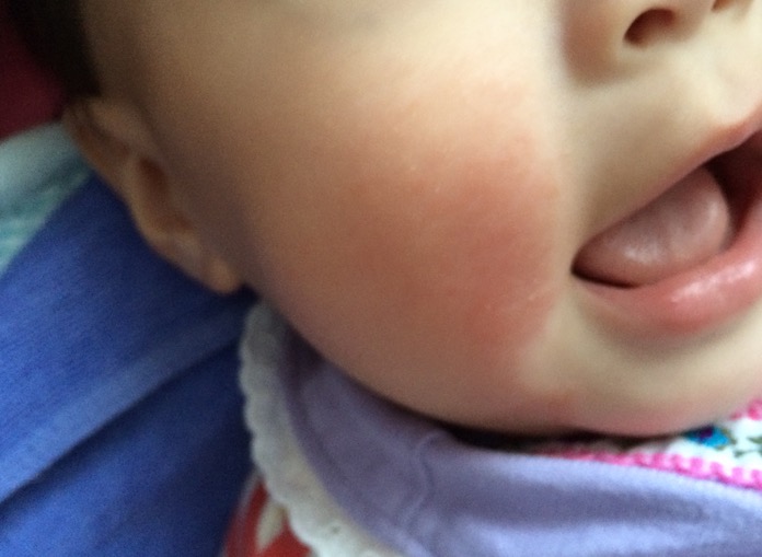 赤ちゃん　頬　肌荒れ　指しゃぶり IMG 1609